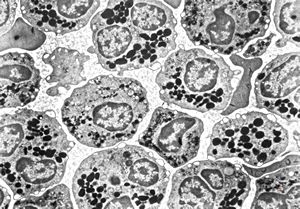 M,32y. | blood - eosinophilic leukemia M,32y. | blood - eosinophilic leukemia